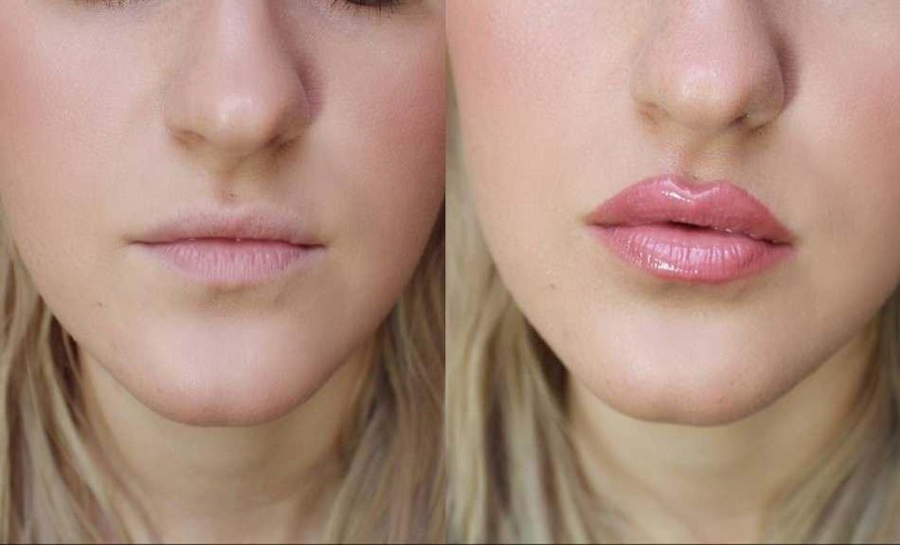 сделанные губы фото до и после