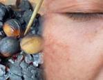 Yüzünüzdeki lekeleri ve yanık izlerini gideren cevizli zeytinyağı karışımı!