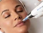 Cildi gen&ccedil;leştirmenin sırrı: Kadınların yeni g&ouml;zdesi kolajen arttıran dermapen işlemi!