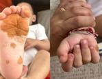 Sosyal medyada g&uuml;ndem oldu! &Ccedil;ocuğunun el ve ayaklarındaki renk değişiminin nedeni şaşırttı