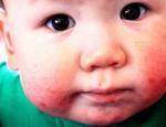 Bebeklerde ağız yaraları nasıl geçer? Bebeklikte ve çocuklarda ağız içi yaraya ne iyi gelir?