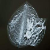 Uzmanından kritik a&ccedil;ıklama: Meme kanserinde hayat kurtaran yenilik