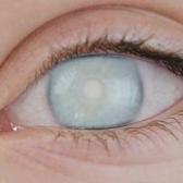 Glokoma karşı tedbir alın: Belirti vermeden ilerliyor, 2 milyon kişiyi hedef alıyor