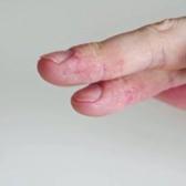 Uzman isim uyardı: Egzaması olan &ccedil;ocuklarda gereksiz diyet alerjiyi tetikleyebilir