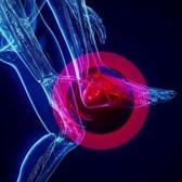 Kronik topuk dikeninde &ccedil;ığır a&ccedil;an y&ouml;ntem: Anjiyografik m&uuml;dahale