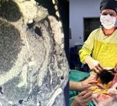 Doktor şaştı kaldı: Dünya literatüründe yok! 90 santimetrelik kedi-köpek kisti çıkarıldı!