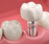 MHP'den milyonları sevindiren kanun teklifi: İmplant SSK kapsamına girebilir