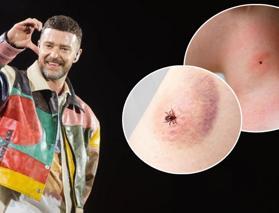 Justin Timberlake gizlediği hastalığını itiraf etti: Lyme hastalığı nedir, neden olur?