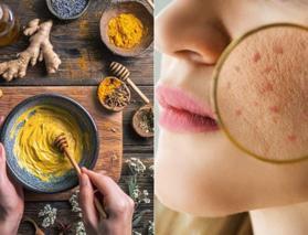 Zerdeçal ve bal maskesiyle aknelere son! Deneyenler çok beğendi