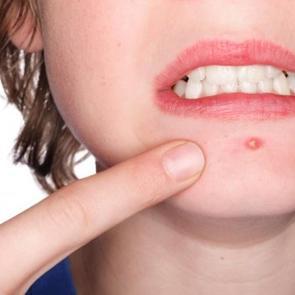 5 dakikada sivilceden kurtulma y&ouml;ntemi