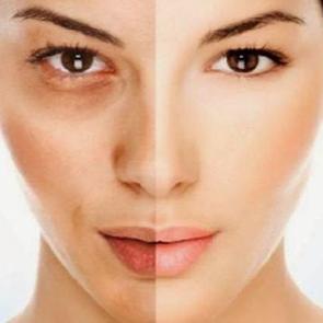 G&ouml;zaltı morluklarına doğal &ccedil;&ouml;z&uuml;m