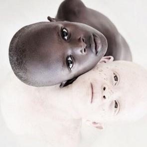 Albinizmli &ccedil;ocukların g&uuml;zellikleri b&uuml;y&uuml;ledi