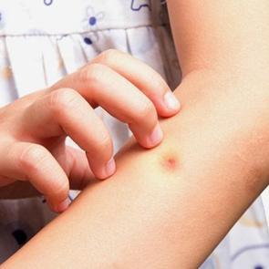 B&ouml;cek ısırıklıklarına karşı ne yapılmalı?