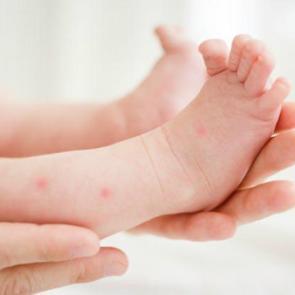 Sinek ısırıklıklarına ilgin&ccedil; &ccedil;&ouml;z&uuml;m