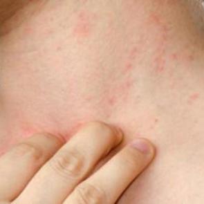 Cilt sivilcelerini yok eden doğal k&uuml;r