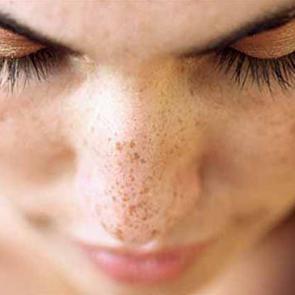 Hamilelikte oluşan lekeler nasıl yok edilir