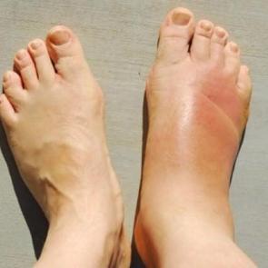 &Ouml;dem oluşmaması i&ccedil;in ne yapılmalı?