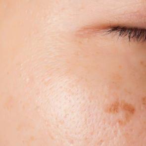 Cilt lekelerinden kurtulmak i&ccedil;in...