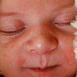 Bebeklerde beyaz nokta neden &ccedil;ıkar?