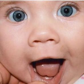 Bebeklerde damak d&uuml;şmesi nedir, neden olur? Belirtileri ve tedavisi...