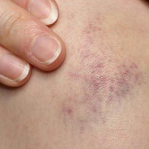 Trombosit (PLT) d&uuml;ş&uuml;kl&uuml;ğ&uuml; nedir? Trombosit d&uuml;ş&uuml;kl&uuml;ğ&uuml; belirtileri nelerdir?