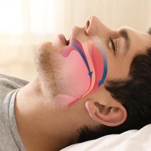 5 dakikada horlamaya son: Horlama neden olur, nasıl ge&ccedil;er? İşte, sebepleri ve tedavisi!