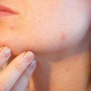 &Ccedil;enede &ccedil;ıkan sivilce i&ccedil;in doğal &ccedil;&ouml;z&uuml;m