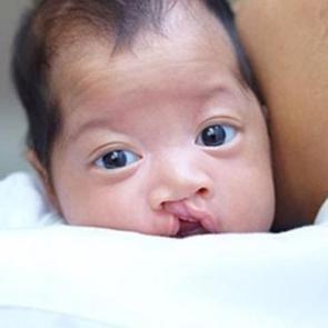 Nager sendromu nedir? Belirtileri nelerdir?