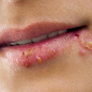 U&ccedil;uğu hızlı ge&ccedil;irmek i&ccedil;in ev yapımı y&ouml;ntemler