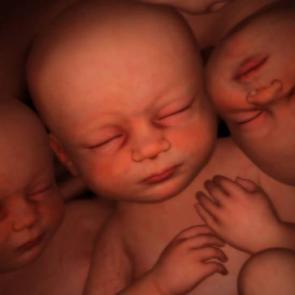 İkizden ikize transf&uuml;zyon sendromu nedir?