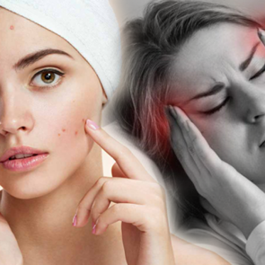 Sivilce baş ağrısı yapar mı?