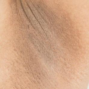 Koltuk altı neden kararır? Koltuk altı kararmasına etkili &ccedil;&ouml;z&uuml;mler