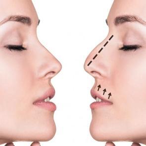 Evde burun k&uuml;&ccedil;&uuml;ltme y&ouml;ntemleri nelerdir? Burun k&uuml;&ccedil;&uuml;lten egzersizler