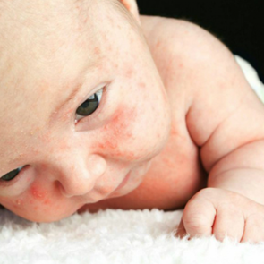 Bebeklerde isilik nasıl ge&ccedil;er? İsilik olan bebeklerde doğal &ccedil;&ouml;z&uuml;mler ve isilik nedenleri