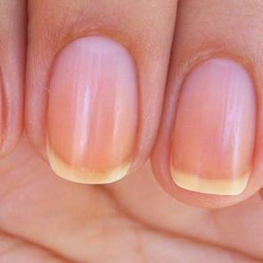 Tırnak neden sararır? Ojeden sararan tırnaklar nasıl beyazlatılır?