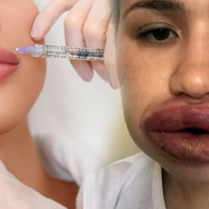 Botoks nedir? Botoks nasıl yapılır? Botoks yaptırmak isteyenler dikkat!