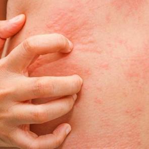 &Uuml;rtiker kurdeşen nedir? Kurdeşen neden olur? Kurdeşen nasıl ge&ccedil;er?