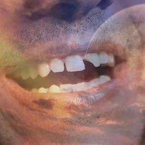 R&uuml;yada diş kırılması neye işaret eder? R&uuml;yada &uuml;st dişlerinin kırıldığını g&ouml;rmek ne anlama gelir?