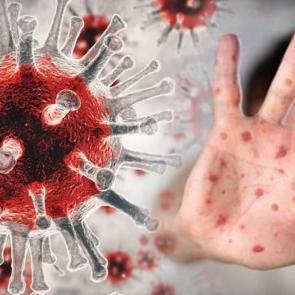  Maymun &ccedil;i&ccedil;eği belirtileri nelerdir? Maymun &ccedil;i&ccedil;eği vir&uuml;s&uuml; tedavisi...