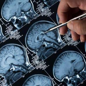 Demansa iyi gelen yiyecekler: Beyin sağlığını destekleyen 3 &ouml;nemli besin!