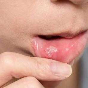 Dudakta u&ccedil;uk neden &ccedil;ıkar, u&ccedil;uk nasıl ge&ccedil;er? Stresten dudak u&ccedil;uklaması...