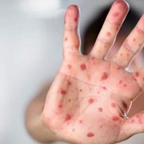 T&uuml;rkiye'de 'maymun &ccedil;i&ccedil;eği' vakası var mı? A&ccedil;ıklama geldi