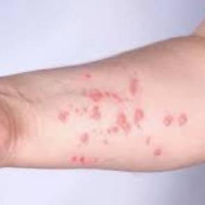 Sağlık Bakanlığı tek tek a&ccedil;ıkladı! Maymun &ccedil;i&ccedil;eğinin belirtileri neler, nasıl bulaşır?