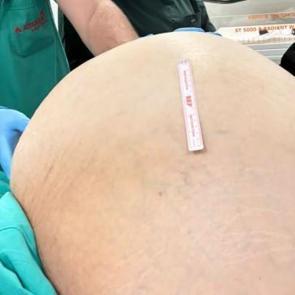 Hepsi karnından &ccedil;ıktı: Tam 23 kilo! Doktorları şaşkına &ccedil;eviren olay