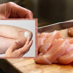 Tavuk alerjisi nedir? Tavuk yedikten sonra bu 5 şeyi yaşıyorsanız&hellip;