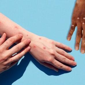 İngiltere&rsquo;de 5. vakanın g&ouml;r&uuml;lmesiyle birlikte uzmanlar &ldquo;maymun &ccedil;i&ccedil;eği vir&uuml;s&uuml;n&uuml;n en sık g&ouml;zden ka&ccedil;an&rdquo; belirtisini a&ccedil;ıkladı!