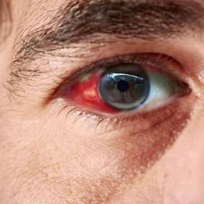 T&uuml;m d&uuml;nya &ldquo;kanayan g&ouml;z vir&uuml;s&uuml;&rdquo; i&ccedil;in alarma ge&ccedil;ti! O &uuml;lkeye seyahat edecekleri DS&Ouml; uyarıyor