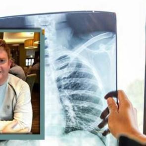 Sigara i&ccedil;meyen kişilerde akciğer kanseri: Hayatına mal oldu!