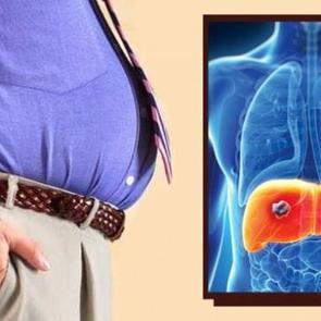 Karaciğer yağlanması karaciğer kanserine sebep oluyor!