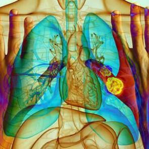 Ellerde akciğer kanseri belirtileri nelerdir?